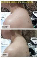 mechanic Ultrasound Treatment for blockage 