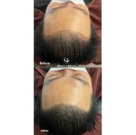 Sense Of Touch Hair Loss Treatment Testimony / ����ѷ����� & ��������
