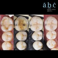 Fillings ����