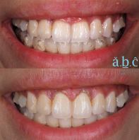 Gingival recontouring