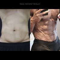 Loose Skin After Weight Loss Treatment in Subang Jaya