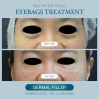 Tear Trough Filler in Subang Jaya