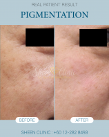 Pico Laser in Subang Jaya