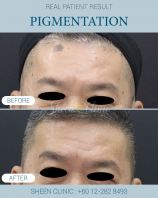 Sunspot Treatment in Subang Jaya