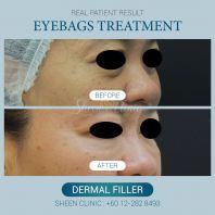        Non-Surgical Eye Bag Removal in Subang Jaya
