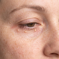 Milia Treatment in Subang Jaya