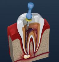 Root Canal