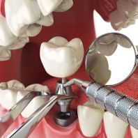 Dental Implants