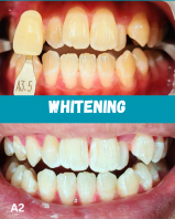 TEETH WHITENING