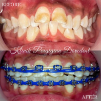 Braces Conventional