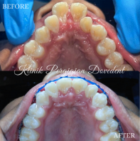 Braces Conventional 