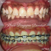 Braces Conventional 