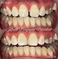 Composite Veneer
