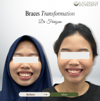 Transformasi Braces