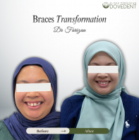 Transformasi Braces