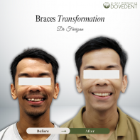 Transformasi Braces