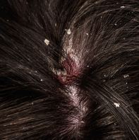 Severe Dandruff Solutions
