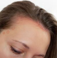 Sensitive Hair Scalp Treatment