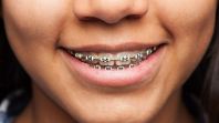 Conventional Braces