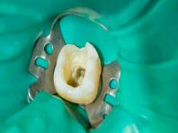 Root Canal Treatment