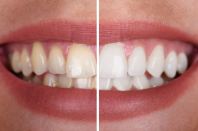 Tooth Whitening