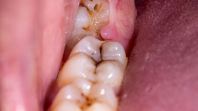 Wisdom Tooth Extraction