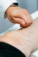 Acupuncture Therapy