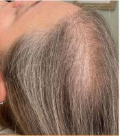Scalp Treatments (Before & After)