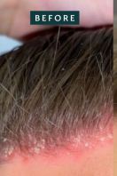 Scalp Treatments (Before & After)