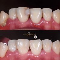 Composite Filling Before & After in Kepong   Real Smile Transformations