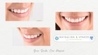 Invisalign