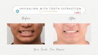 Invisalign