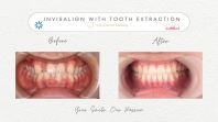 Invisalign