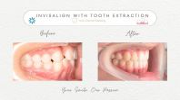 Invisalign