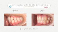 Invisalign