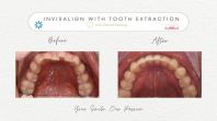 Invisalign