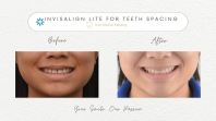 Invisalign