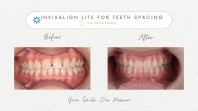 Invisalign
