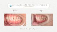 Invisalign