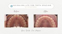 Invisalign