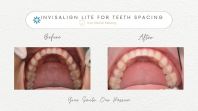 Invisalign