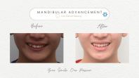 Invisalign