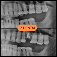 Dental Implant