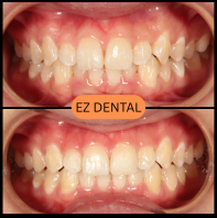 Clear Aligners