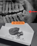 Wisdom Tooth Surgery