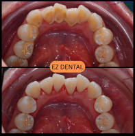 Scaling and Polishing