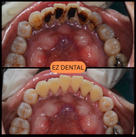 Scaling and Polishing