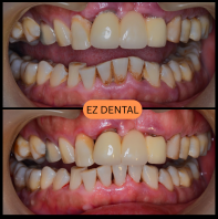 Scaling and Polishing
