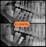 Dental Implant