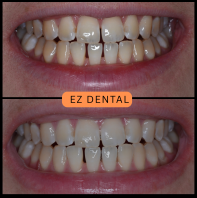 Teeth Whitening